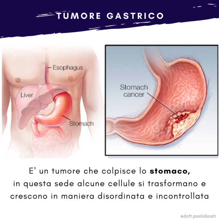 Tumore Dello Stomaco O Neoplasia Gastrica Dott Boati